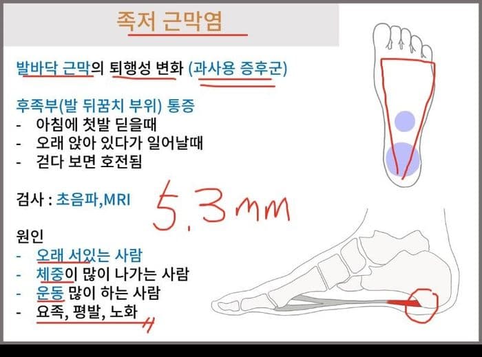 족저근막염 설명 위에 펜으로 두께와 통증 부위를 표시한 설명서