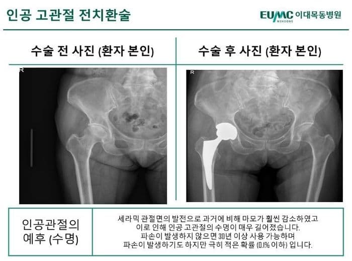 인공고관절 전치환술 수술 전후 엑스레이를 나란히 보여 주는 설명서